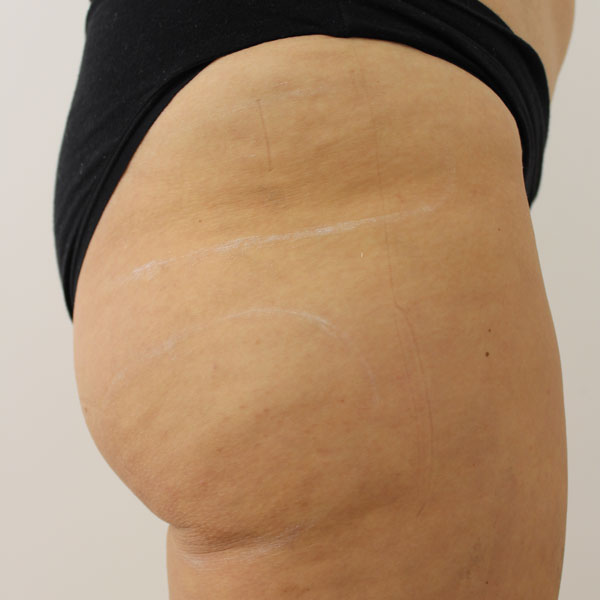 BSC-cellulite-treatment-after