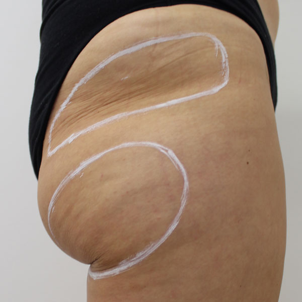 BSC-cellulite-treatment-before