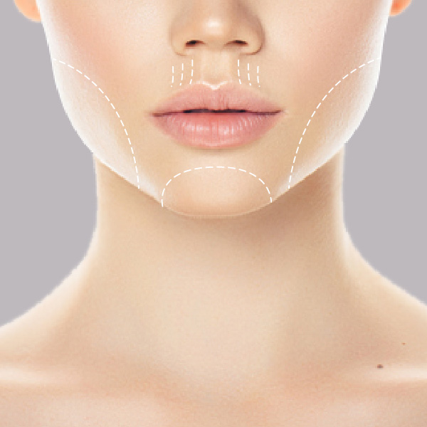 HIFU-lower-face-treatment-areas