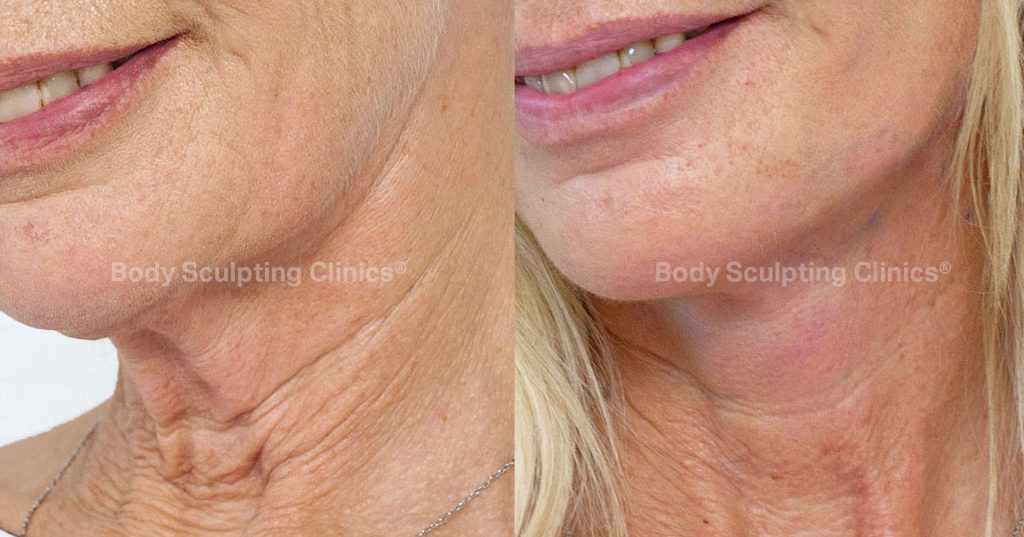 APTOS Thread Lift Fix Saggy Skin Body Sculpting Clinics