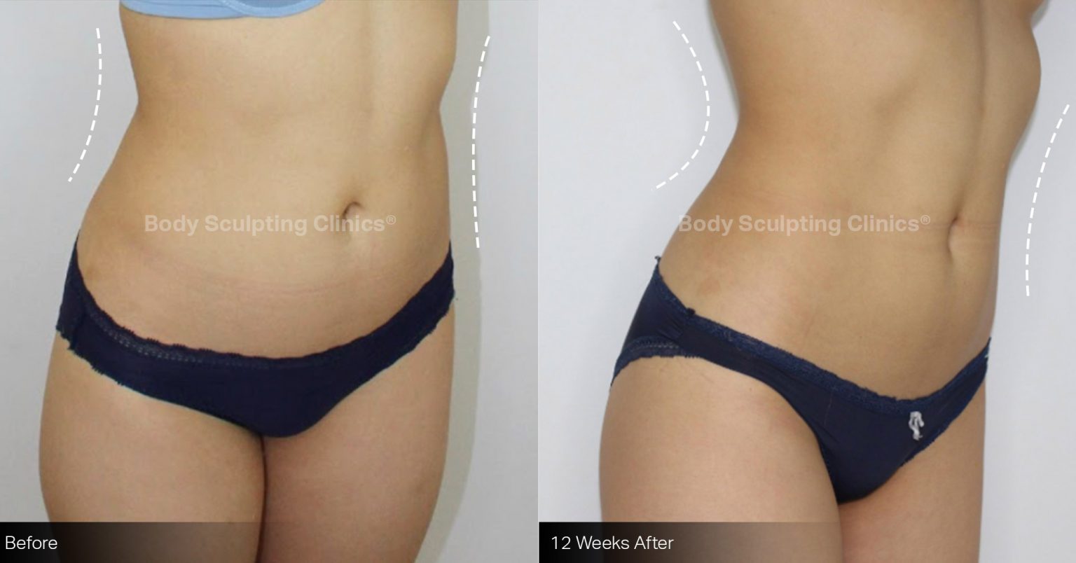 Before and After | Body Sculpting Clinic