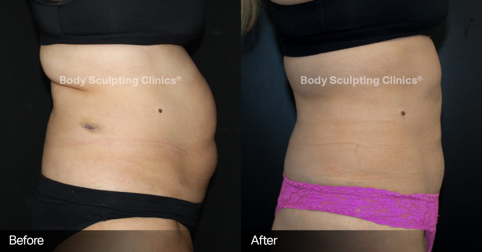 EMBODY™ ABDOMINAL SEPARATION | Body Sculpting Clinics