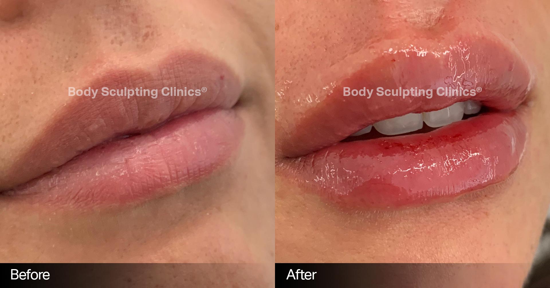 lip-chin-filler-body-sculpting-clinics-2