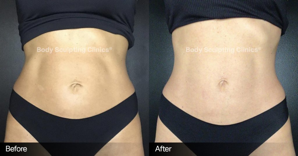 Before and After  Body Sculpting Clinics