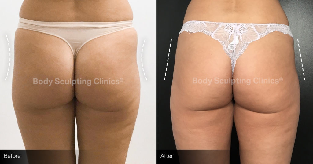 hip-dips-001 (1) Cellulite Reduction before and after 1