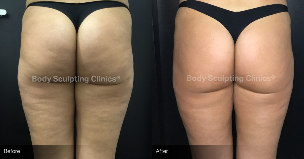 sculptra-1 (1) Cellulite Reduction before and after sculptra-1 (1)