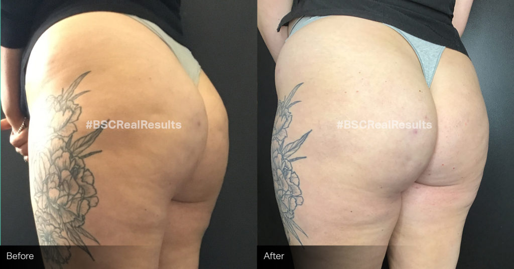 sculptra-1 copy Cellulite Reduction before and after sculptra-1 copy