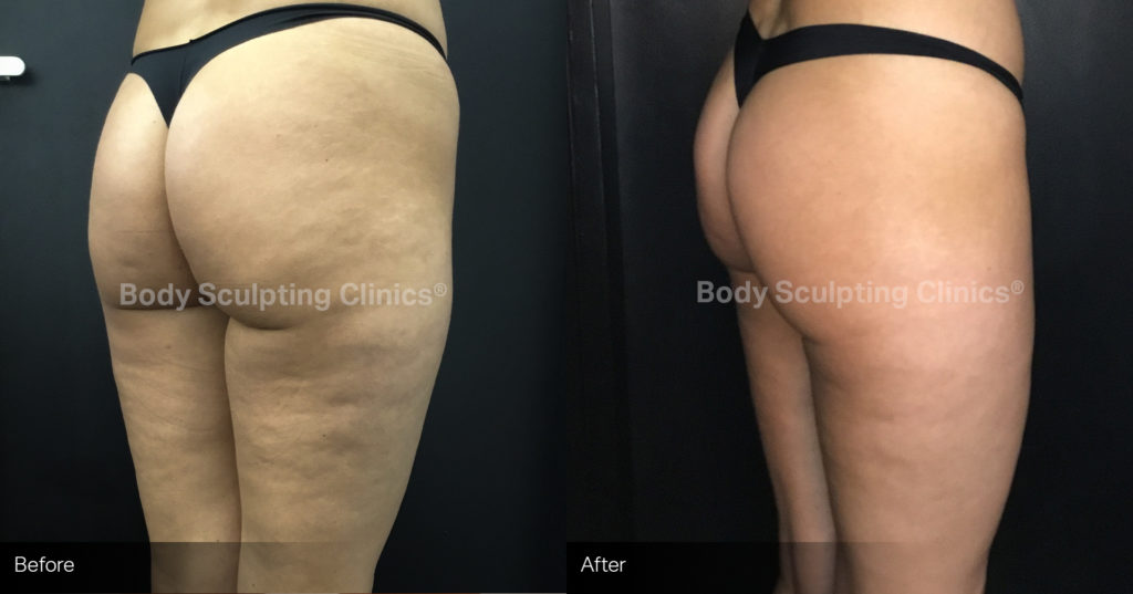 sculptra-2 Cellulite Reduction before and after sculptra-2