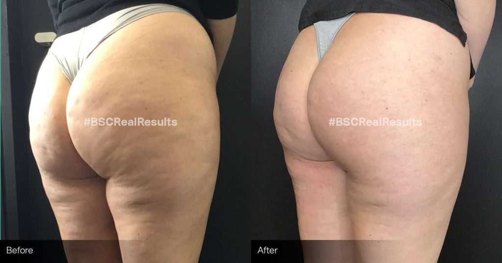 sculptra-2 (2) Cellulite Reduction before and after