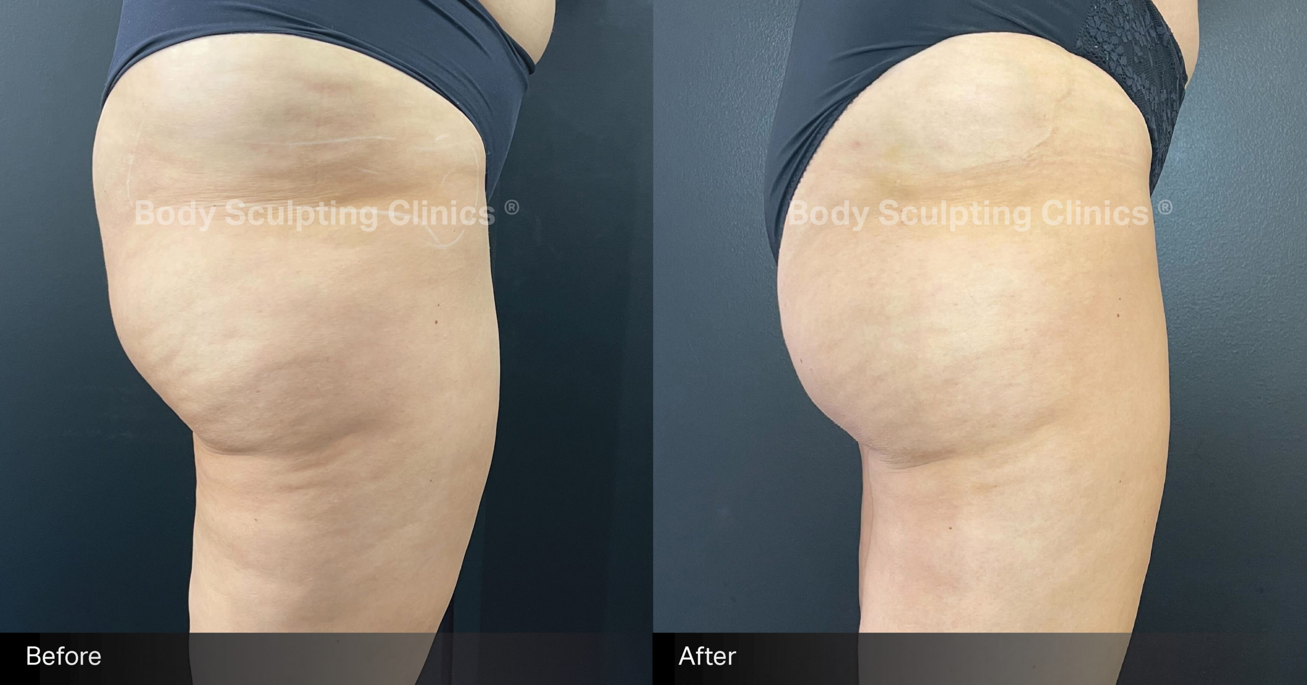 sculptra-cellulite-Female-5