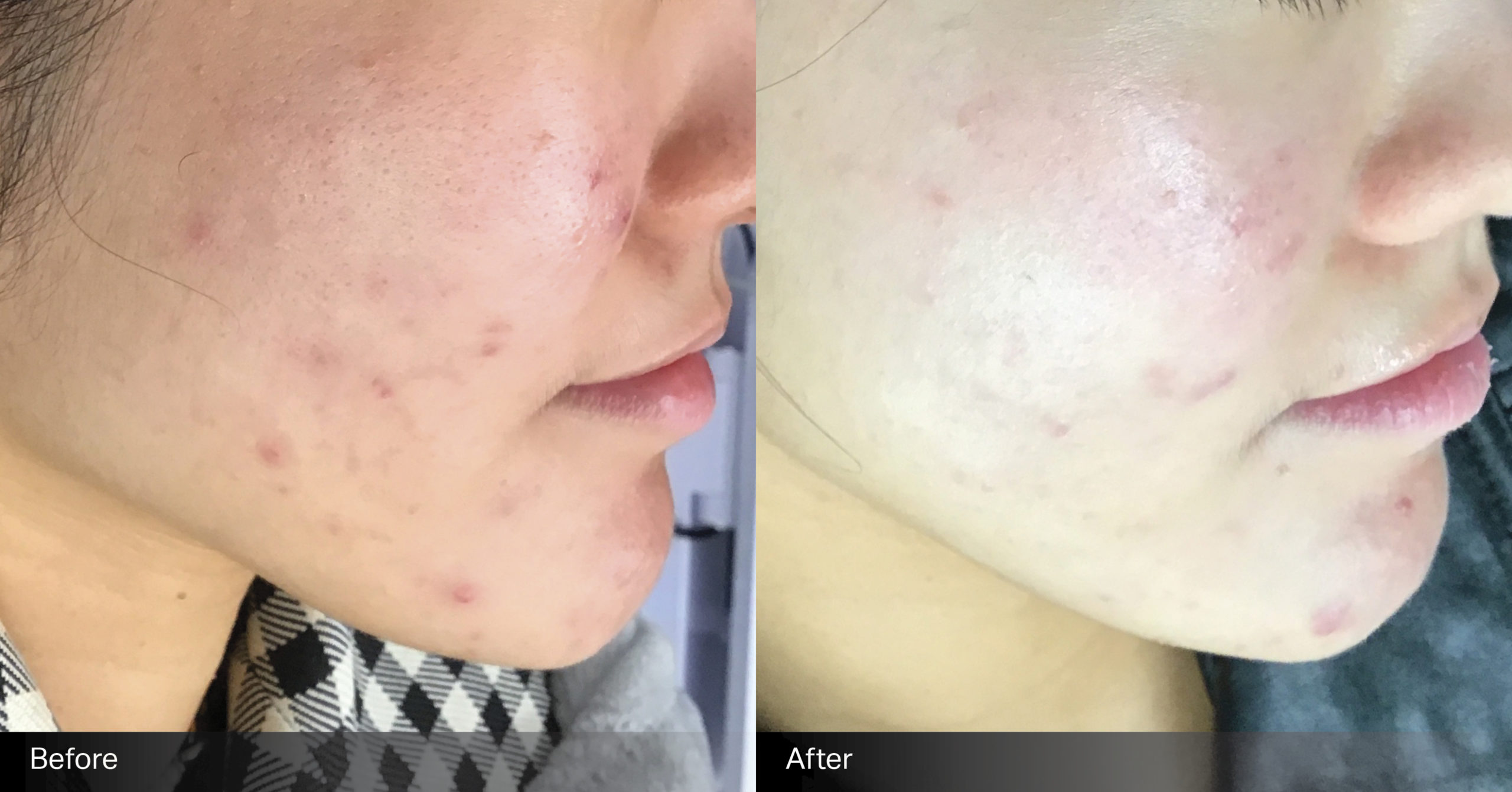 body-sculpting-clinics-skin-led-peels-3