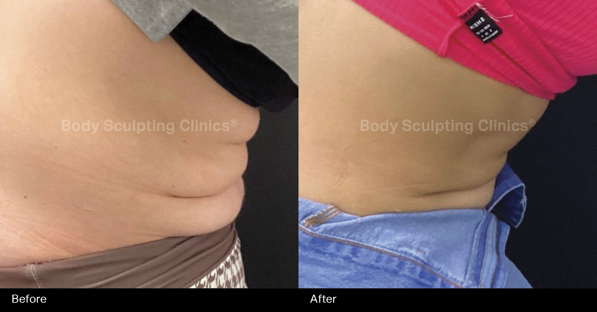 hifu-permanent-fat-reduction-abs-before-after