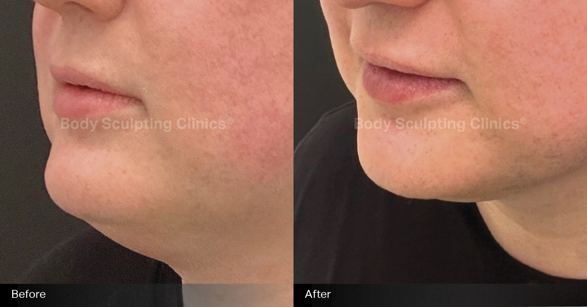 hifu-permanent-fat-reduction-chin-2