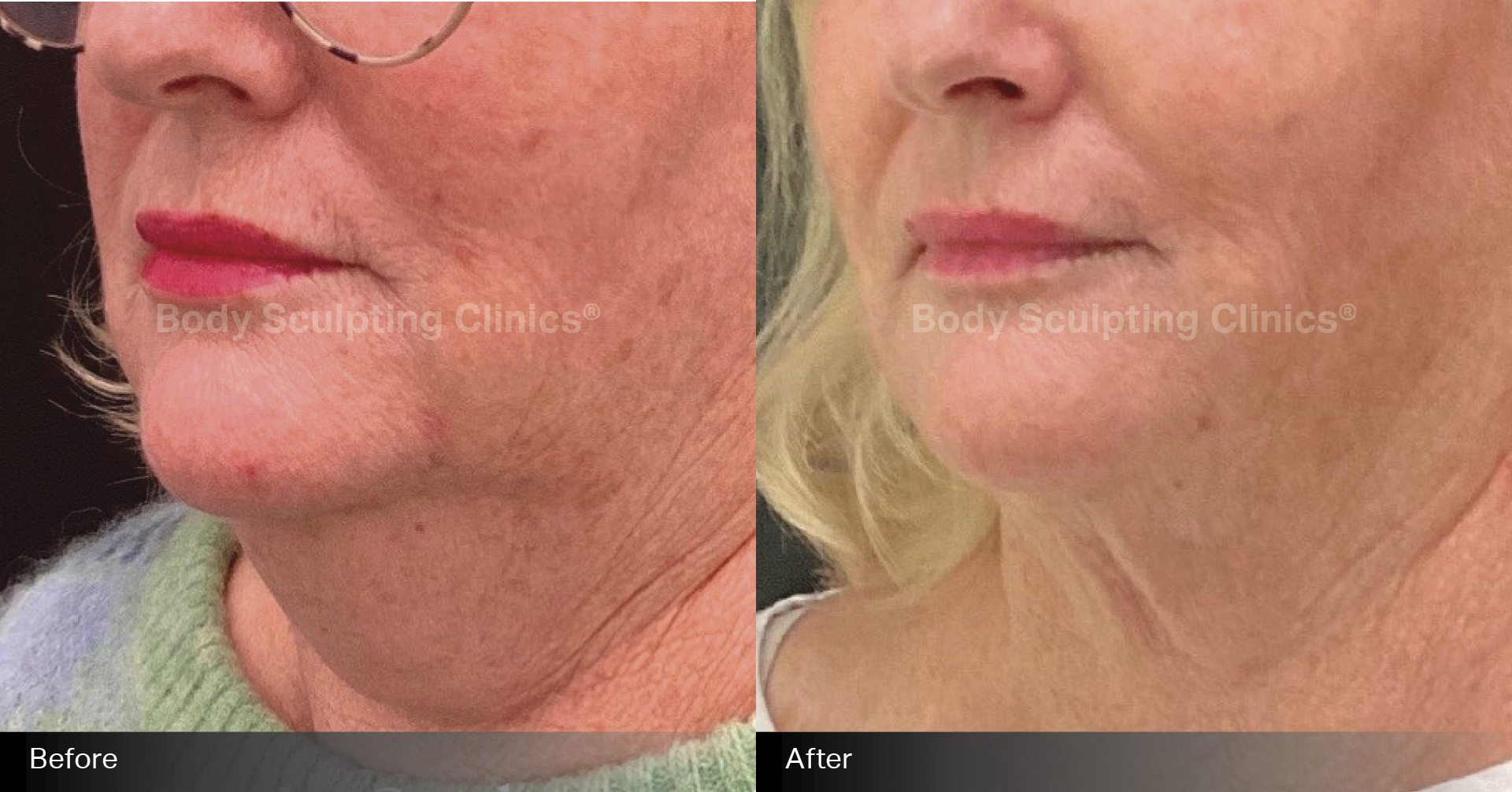 permanent-fat-reduction-chin-1