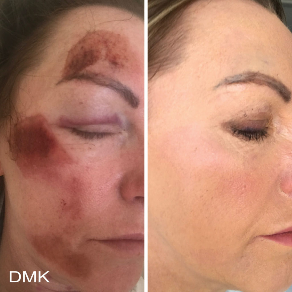 DMK-body-sculpting-clinics-before-after-acne-00005 DMK-body-sculpting-clinics-before-after-acne-00005