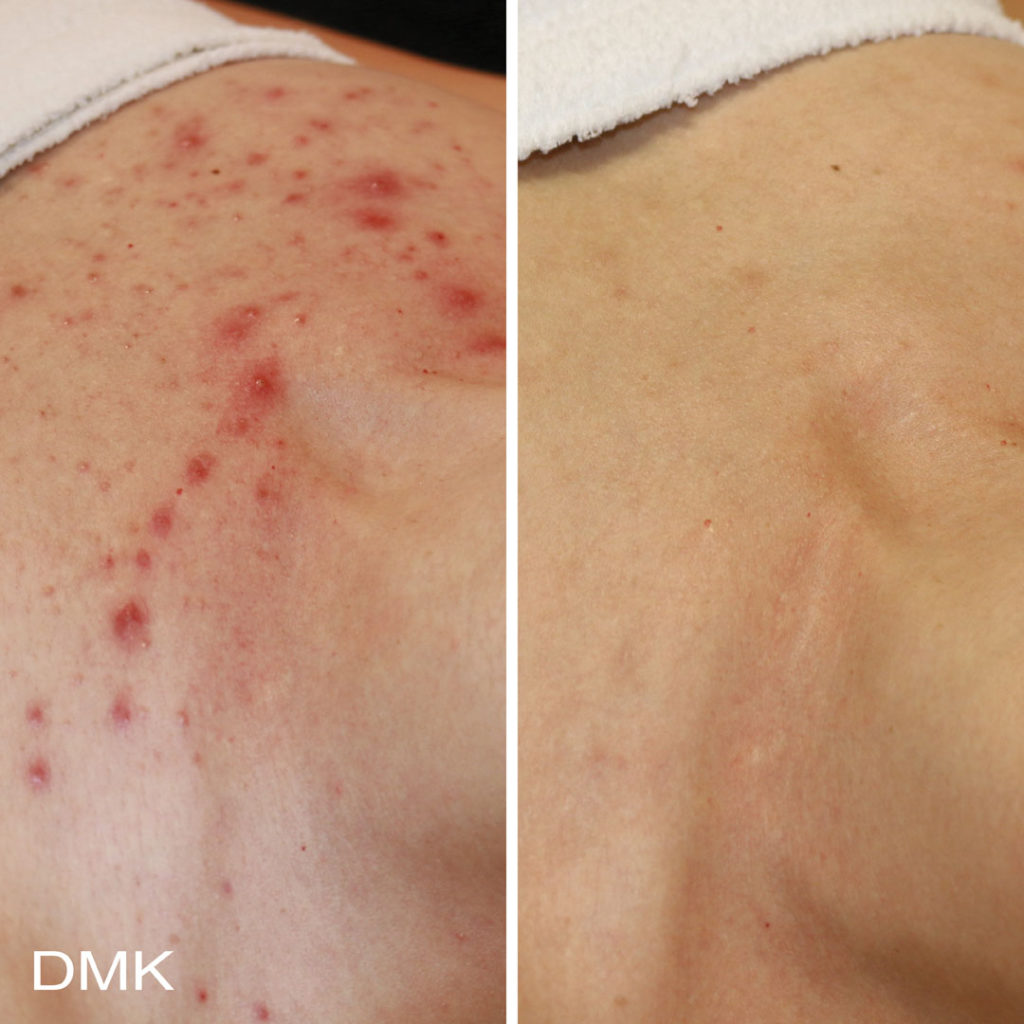 DMK-body-sculpting-clinics-before-after-acne-00006 DMK-body-sculpting-clinics-before-after-acne-00006
