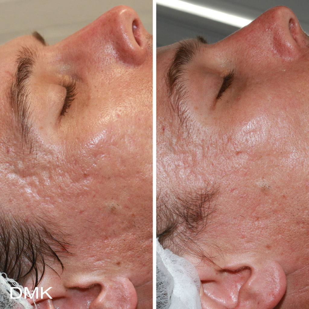DMK-body-sculpting-clinics-before-after-acne-00007 DMK-body-sculpting-clinics-before-after-acne-00007