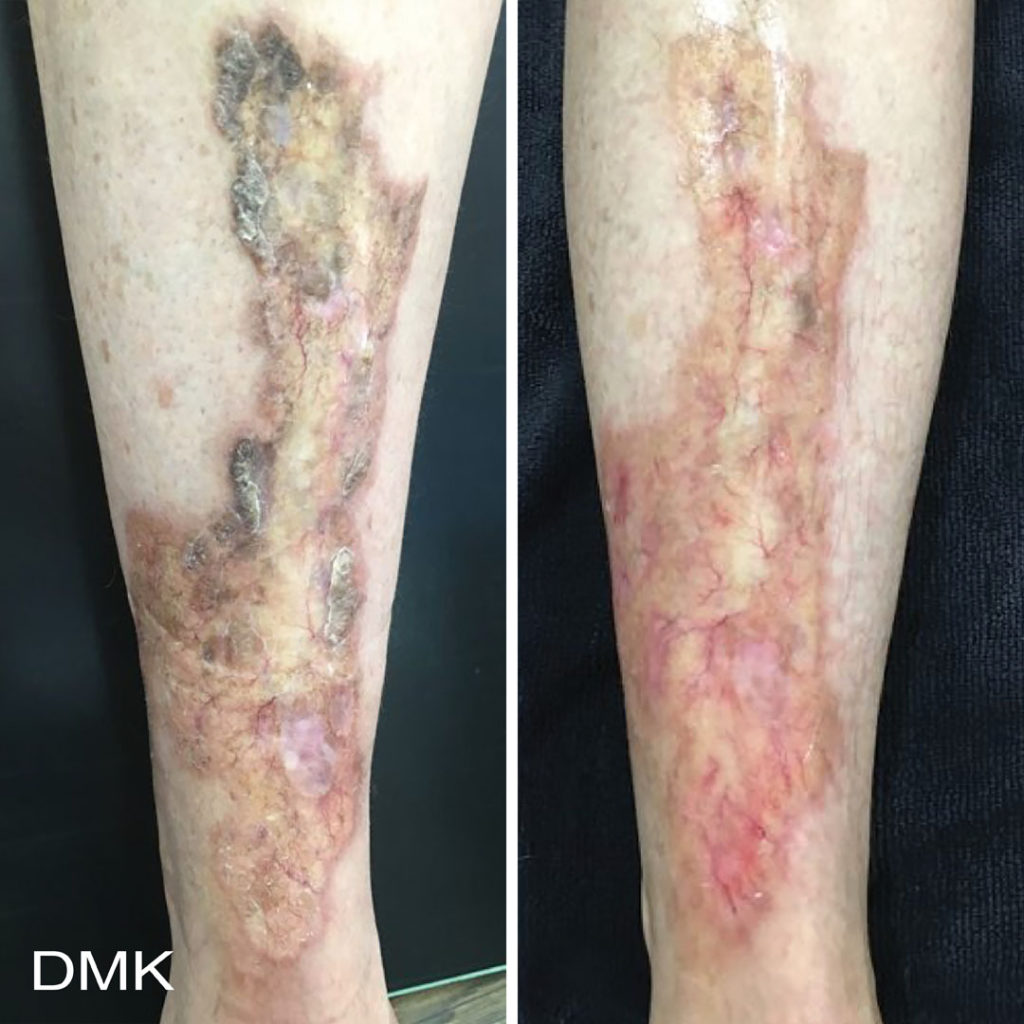 DMK-body-sculpting-clinics-before-after-acne-00009 DMK-body-sculpting-clinics-before-after-acne-00009