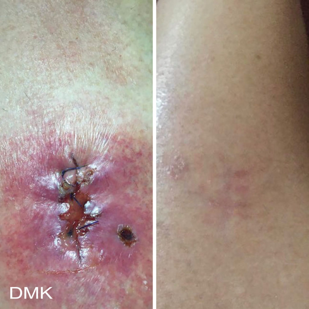 DMK-body-sculpting-clinics-before-after-acne-00010 DMK-body-sculpting-clinics-before-after-acne-00010