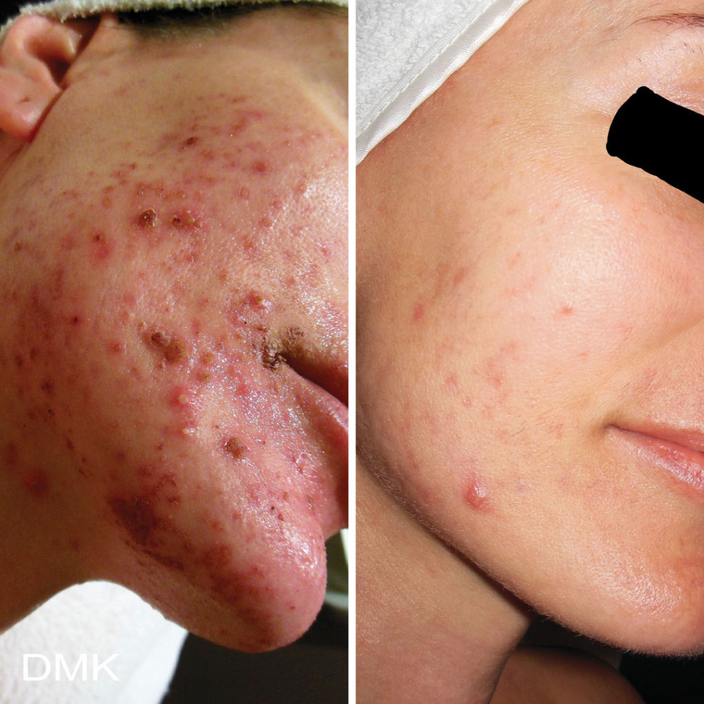 DMK-body-sculpting-clinics-before-after-acne-00012 DMK-body-sculpting-clinics-before-after-acne-00012