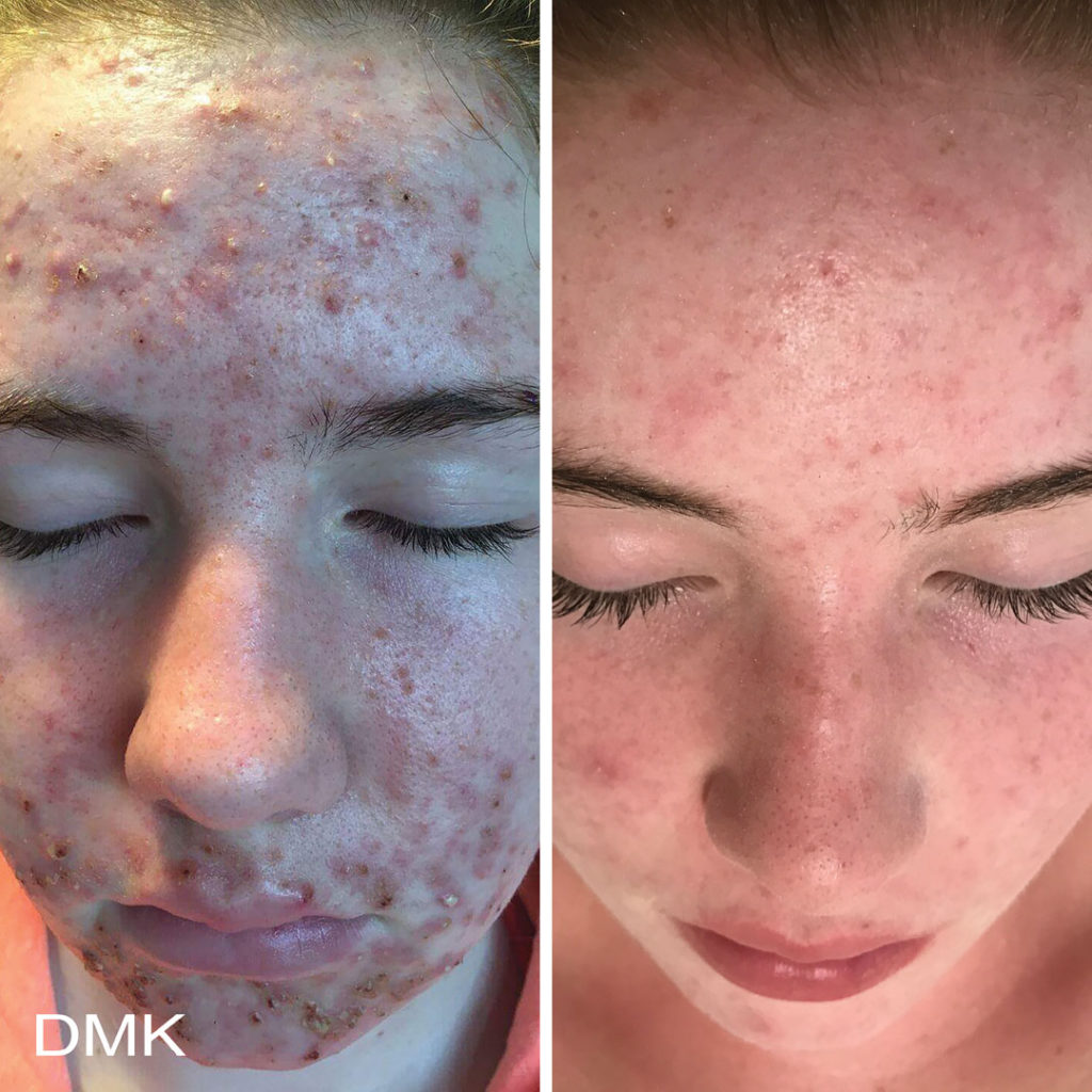 DMK-body-sculpting-clinics-before-after-acne-00013 DMK-body-sculpting-clinics-before-after-acne-00013