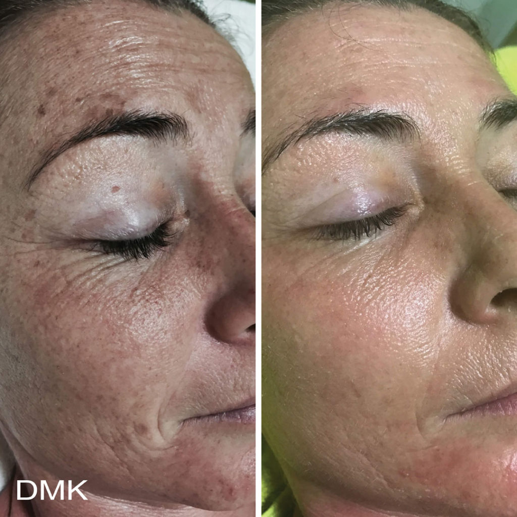 DMK-body-sculpting-clinics-before-after-aging-00001 DMK-body-sculpting-clinics-before-after-aging-00001