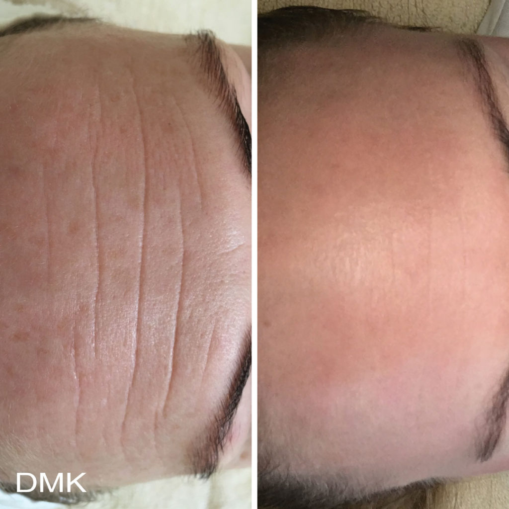 DMK-body-sculpting-clinics-before-after-aging-00003 DMK-body-sculpting-clinics-before-after-aging-00003