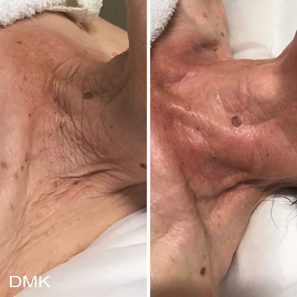 DMK-body-sculpting-clinics-before-after-aging-00014 DMK-body-sculpting-clinics-before-after-aging-00014
