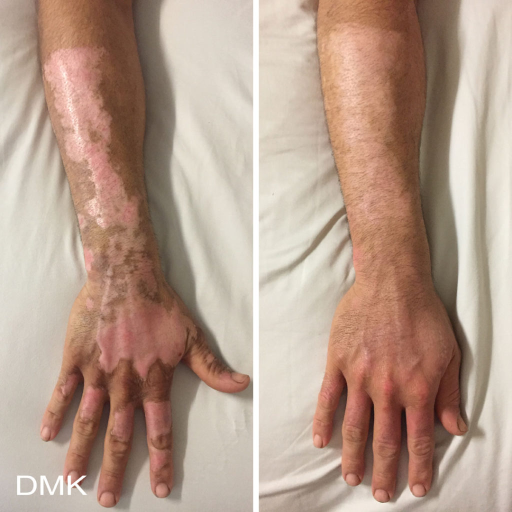 DMK-body-sculpting-clinics-before-after-betagel-00001 DMK-body-sculpting-clinics-before-after-betagel-00001