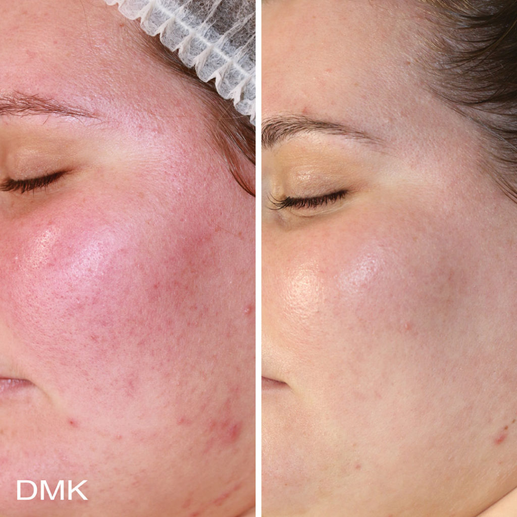 DMK-body-sculpting-clinics-before-after-reactive-skin-00002 DMK-body-sculpting-clinics-before-after-reactive-skin-00002