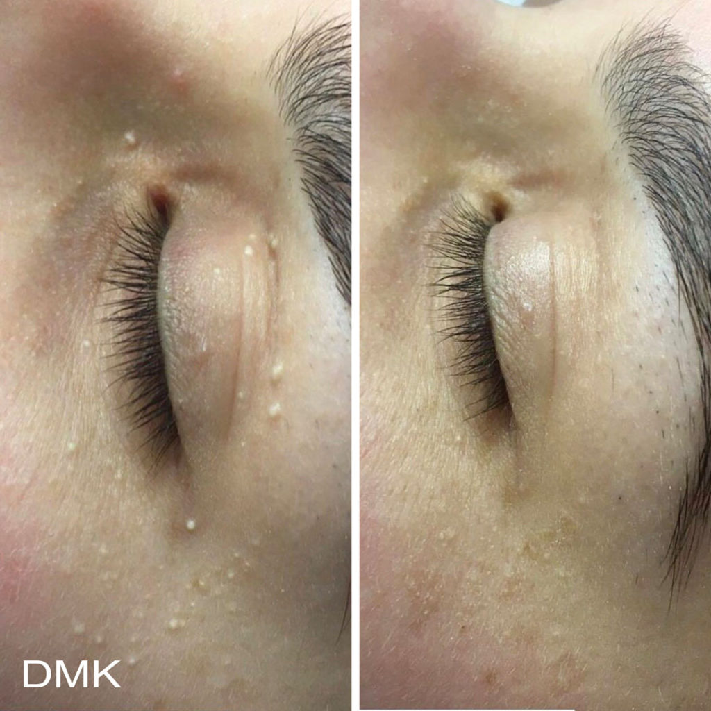DMK-body-sculpting-clinics-before-after-reactive-skin-00006 DMK-body-sculpting-clinics-before-after-reactive-skin-00006