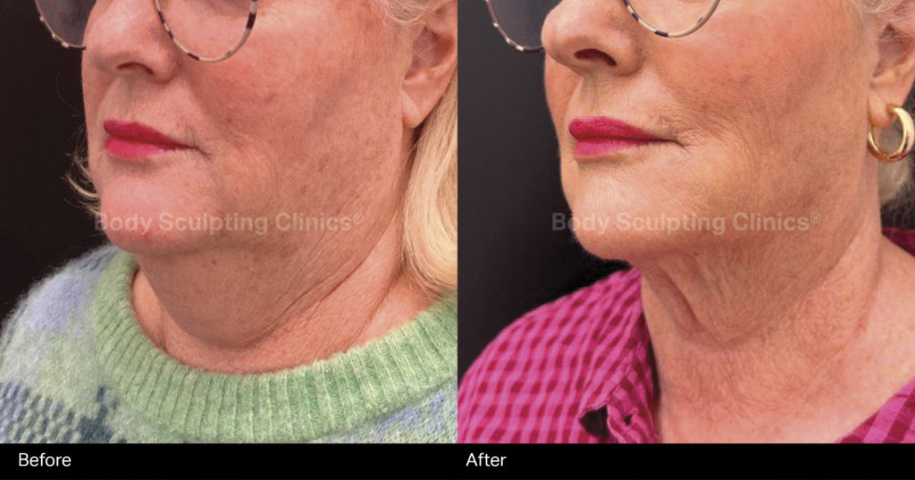 hifu-lower-face-B+A-3