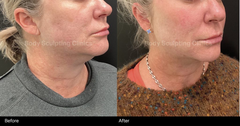 hifu-lower-face-female-B+A-1