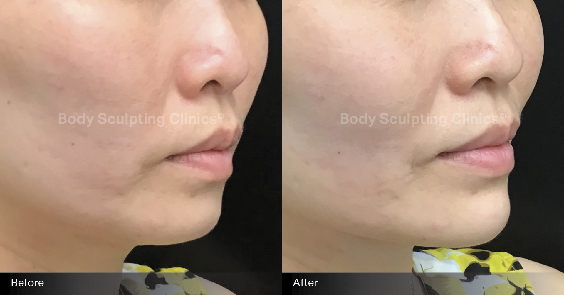 1ml-chin-filler-2