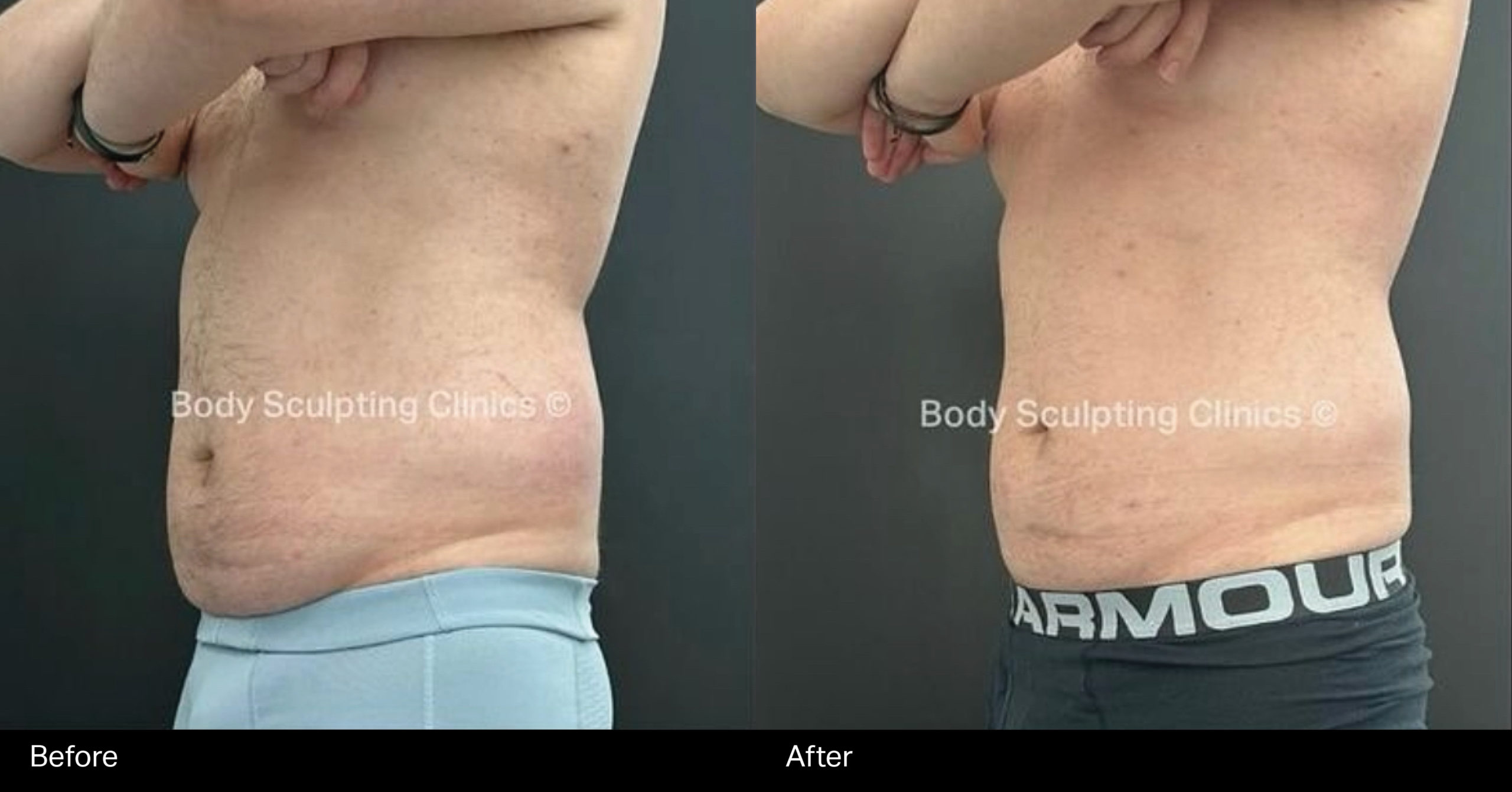 Cryo-male-fat-freezing-abs-1