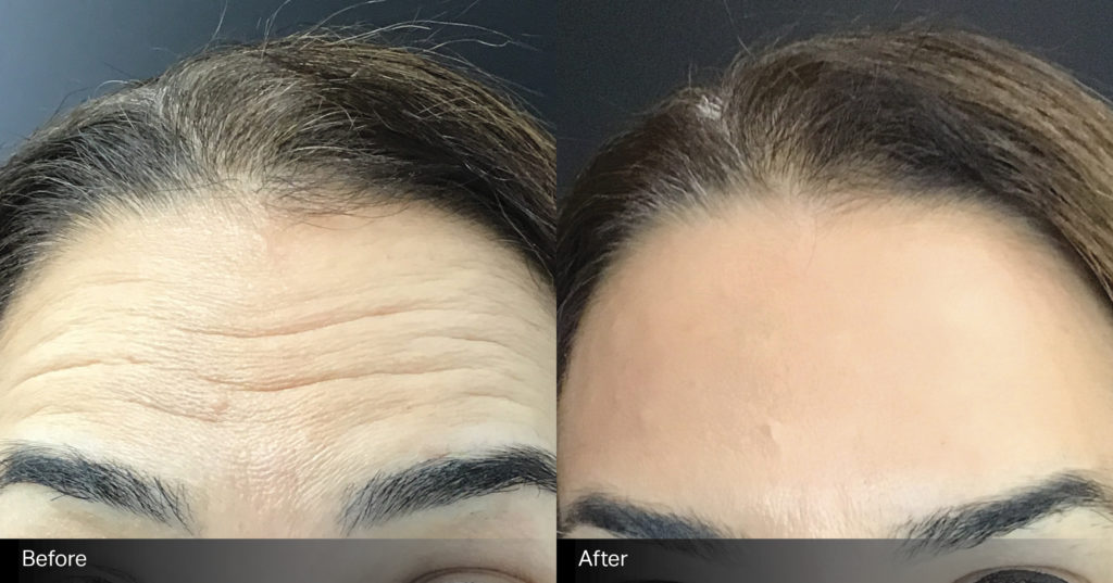 anti-wrinkle-B+A-1
