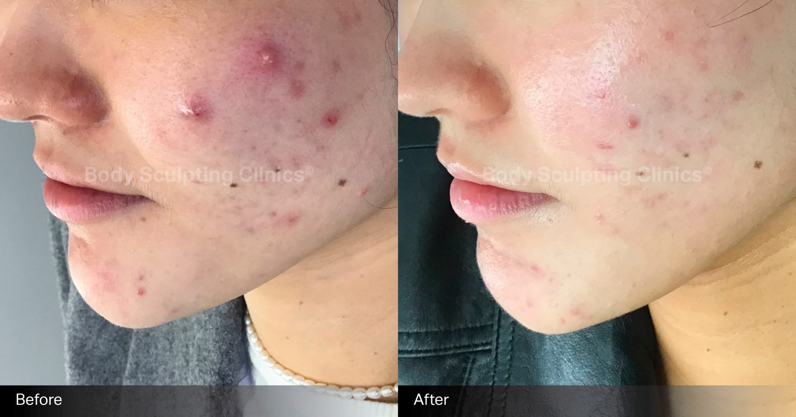 body-sculpting-clinics-skin-led-peels-1