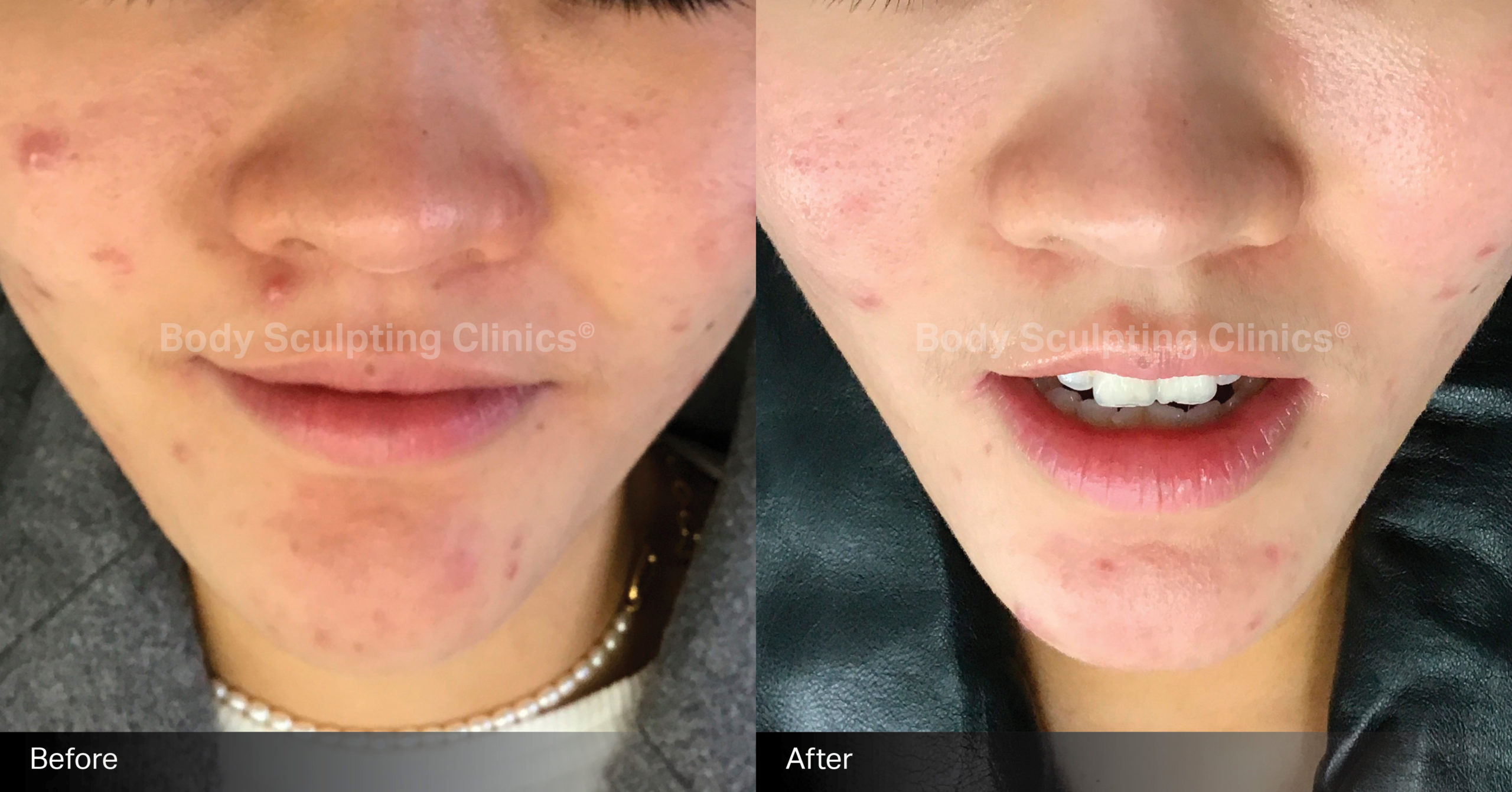 body-sculpting-clinics-skin-led-peels-2