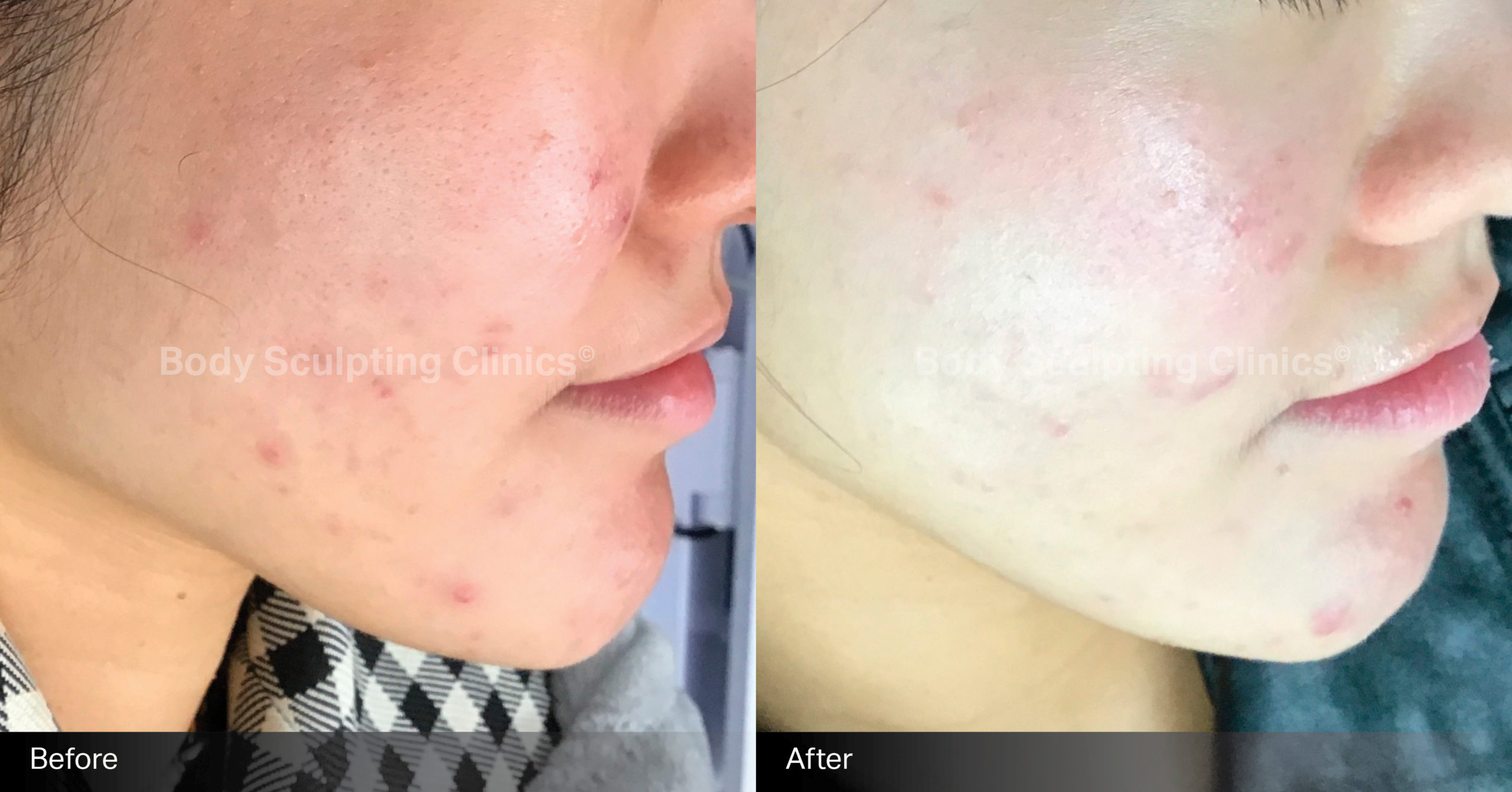 body-sculpting-clinics-skin-led-peels-3