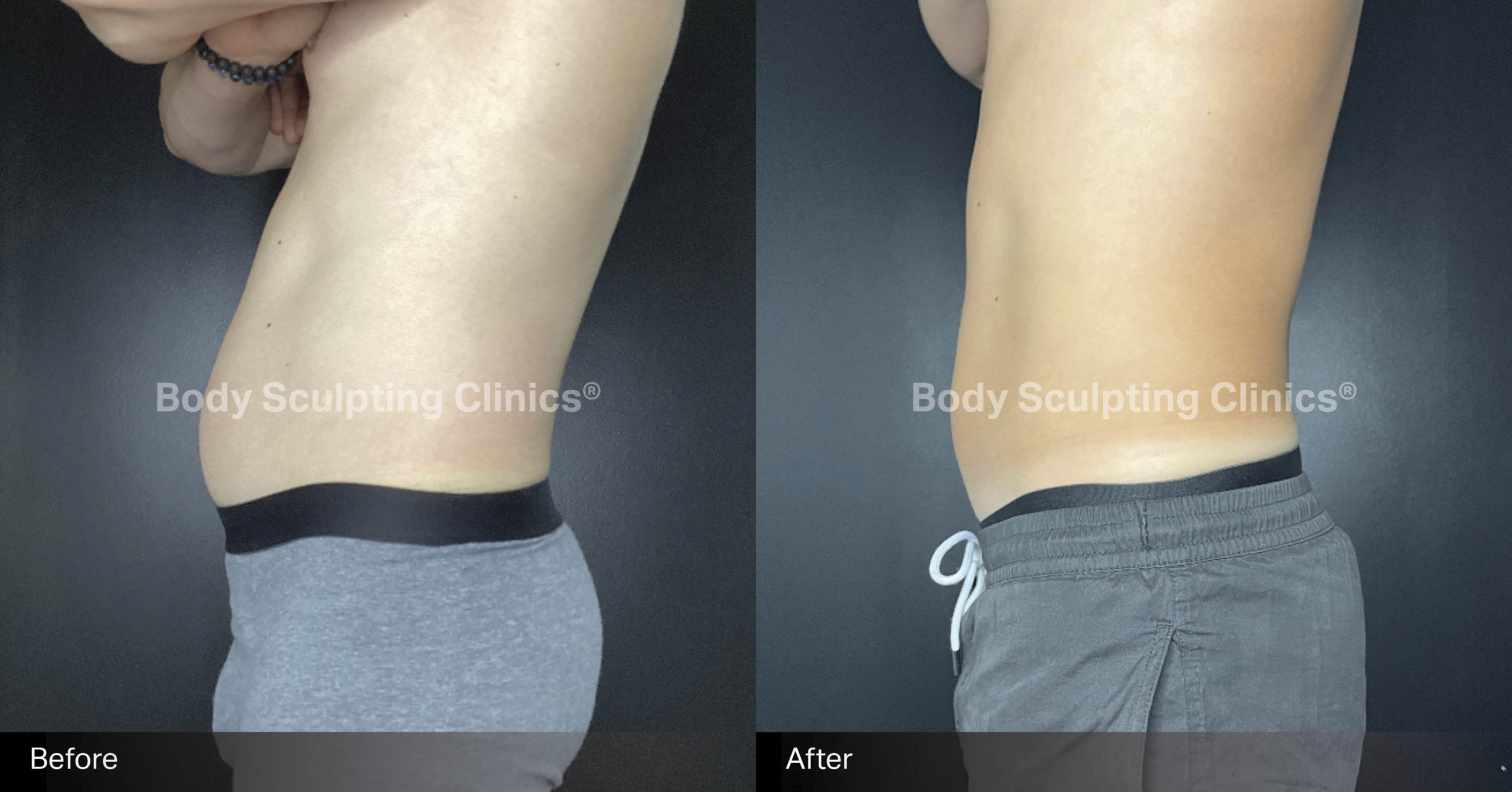 embody-abs-before-after-2
