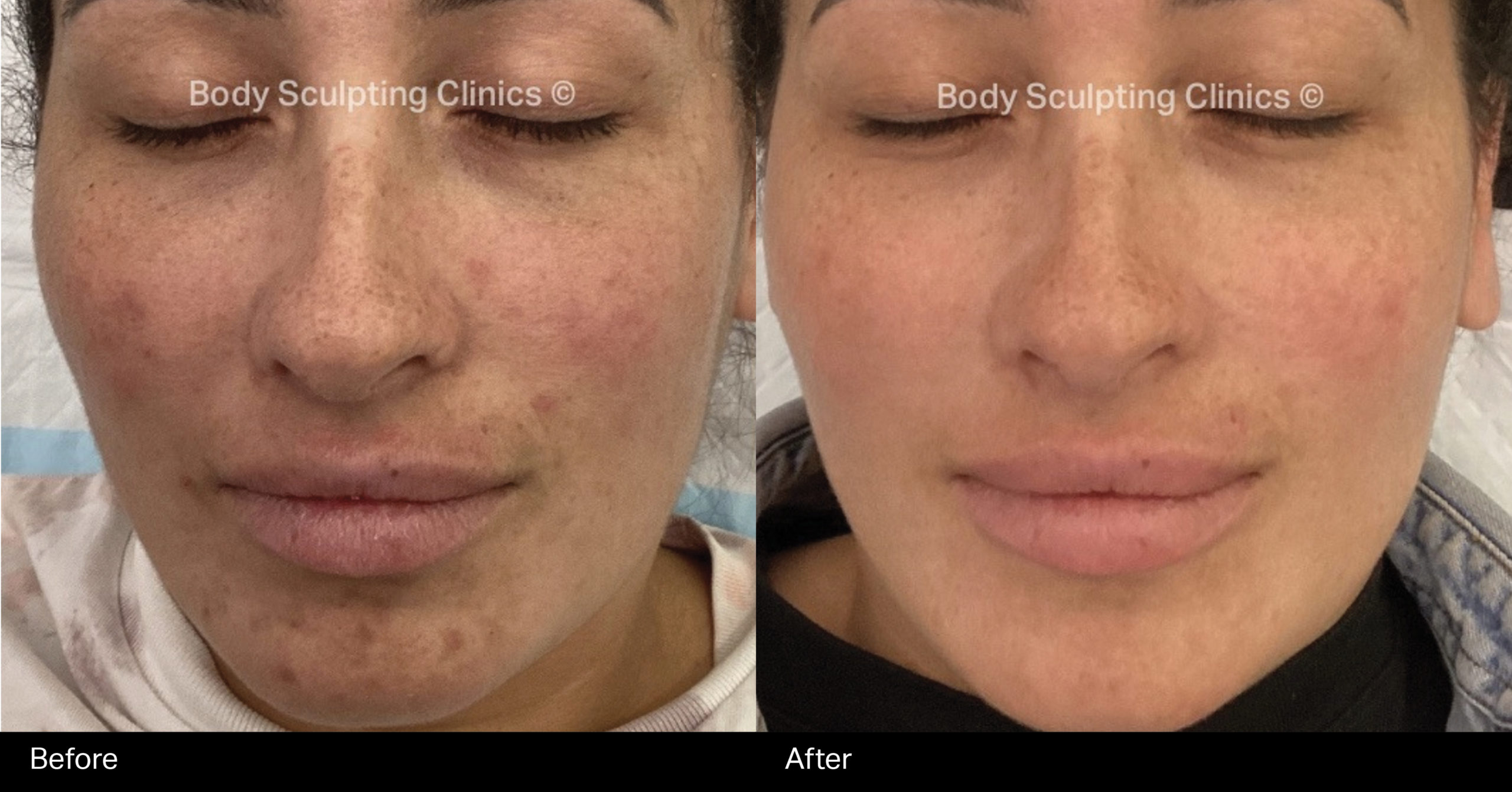 dermal-peels-1