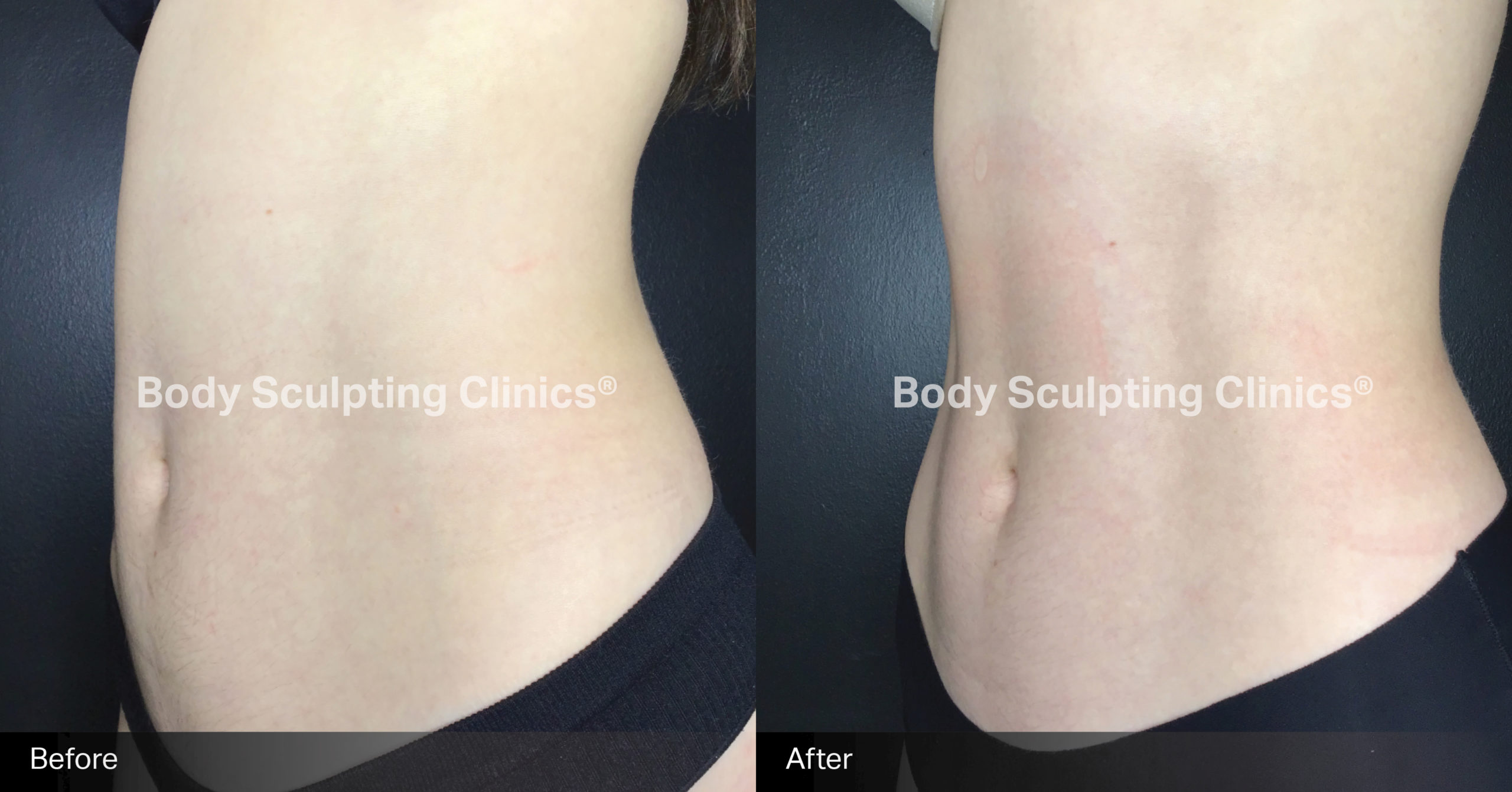embody-abs-before-after