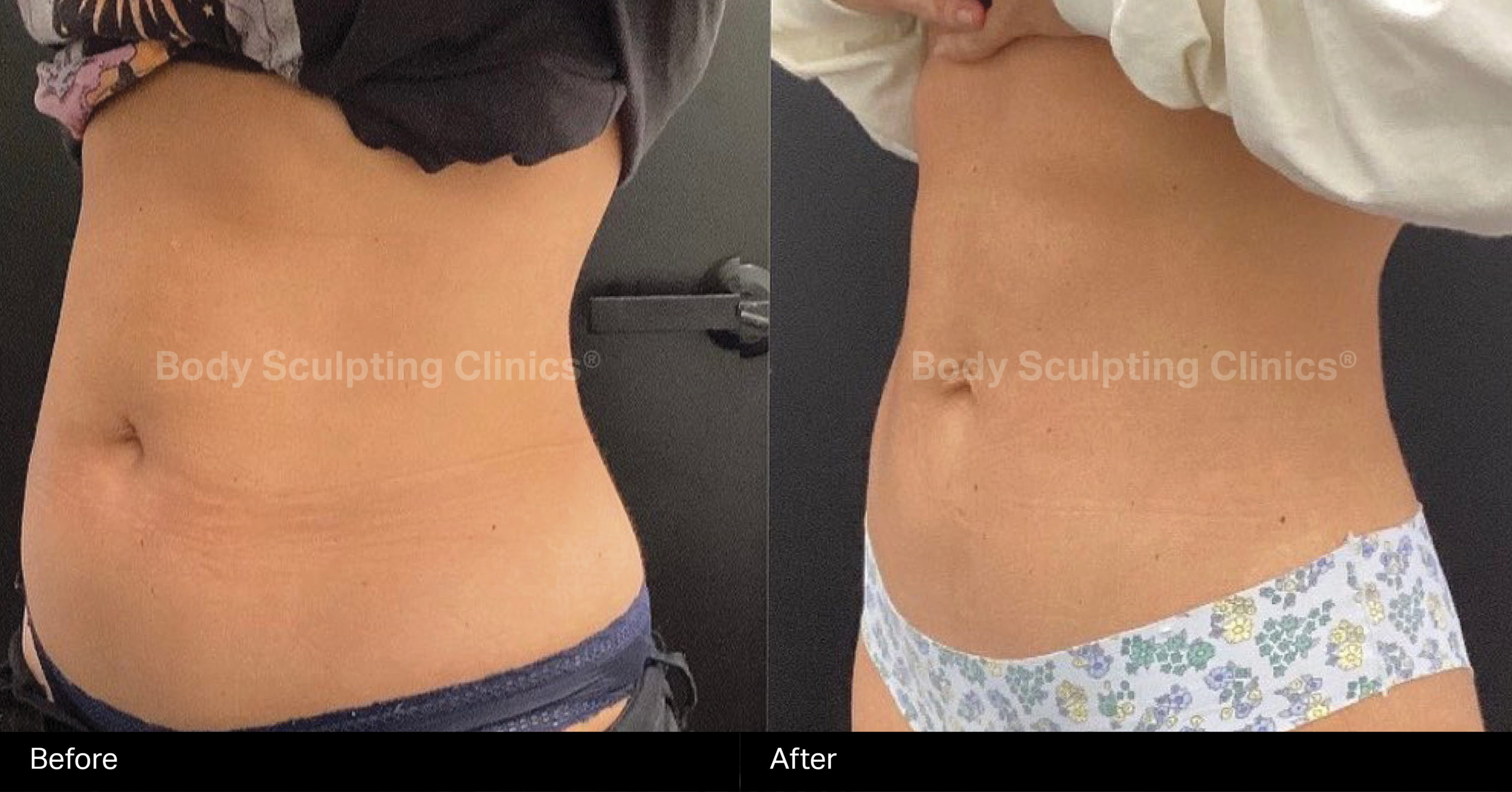 embody-abs-before-after-5