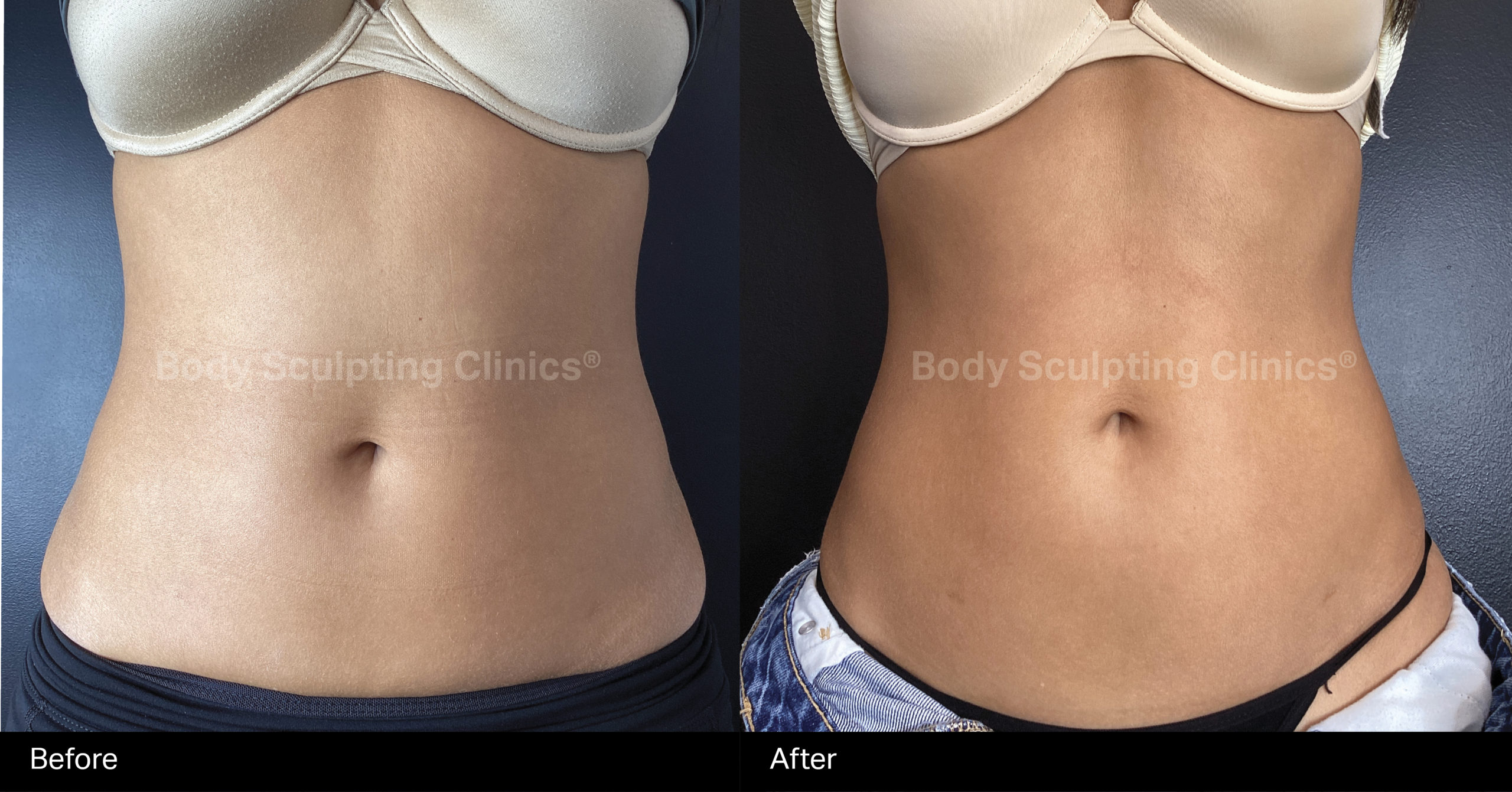 embody-abs-before-after-4