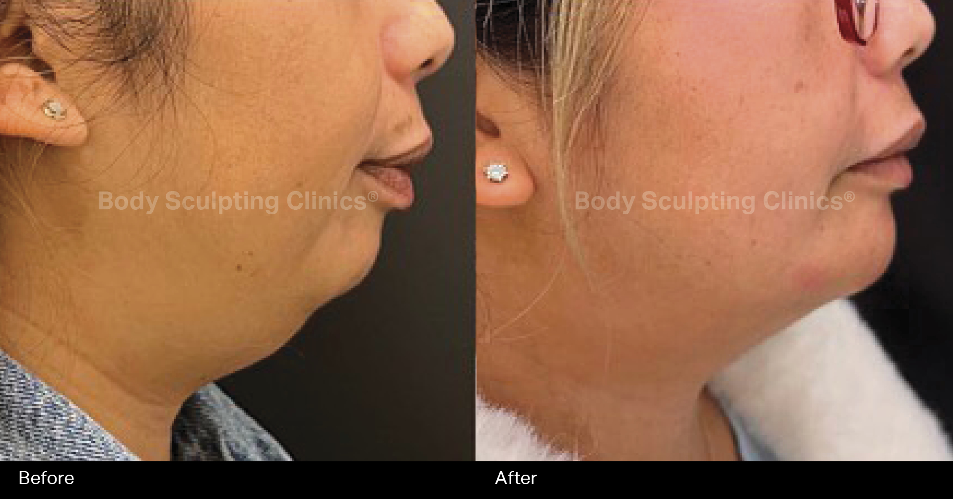 fat-freezing-chin-dermal-filler-1