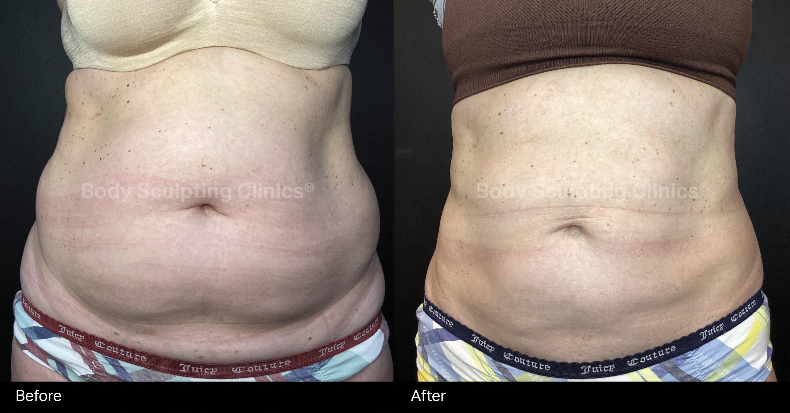 fat-freezing-female-lower-upper-abs-love-handles-3