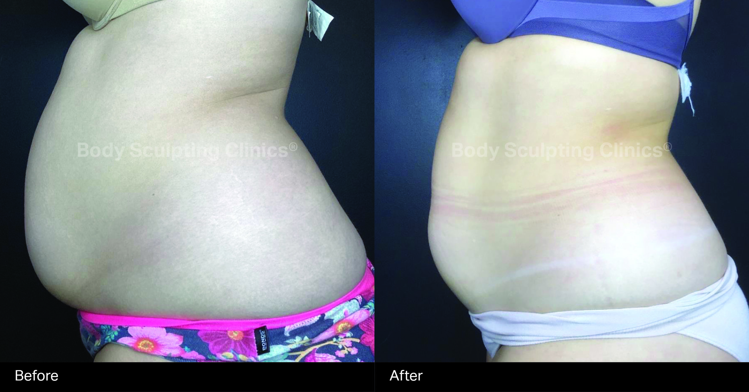 fat-reduction-body-B+A-1