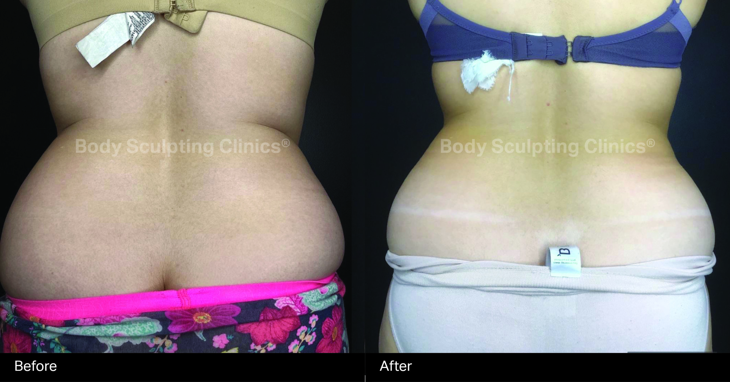 fat-reduction-body-B+A-2