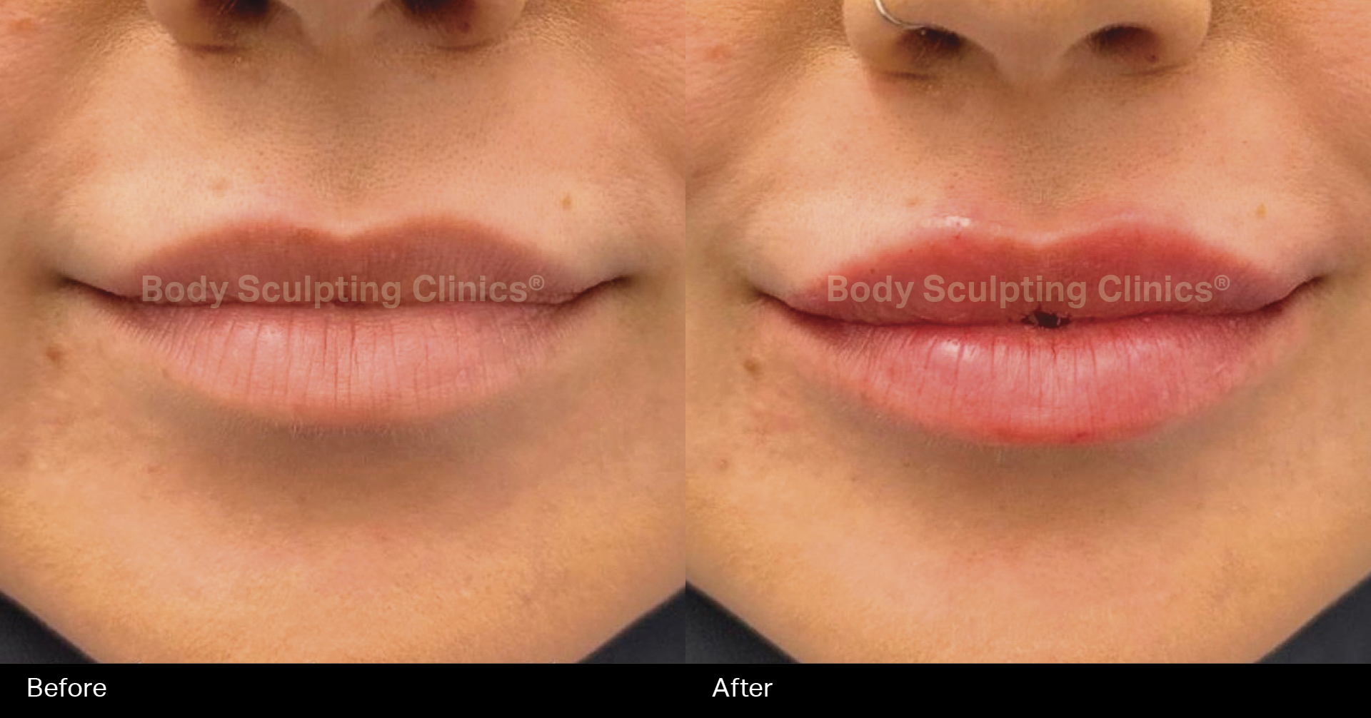 lip-filler-female1