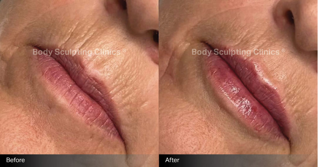 lips-dermal-filler-Female-1